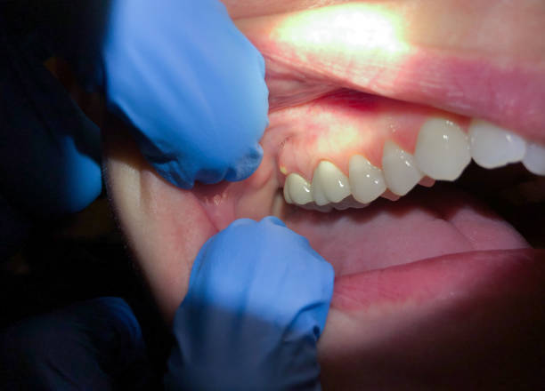 Best Emergency Tooth Extraction in Stephens City, VA